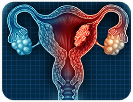 Cáncer Ginecológico de Útero o Endometrio.